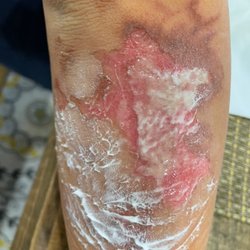 Two days after treatment