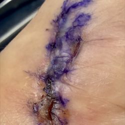 Hand Microsurgery & Reconstruction Orthopaedics - The incision, following the removal of the first incorrect cast