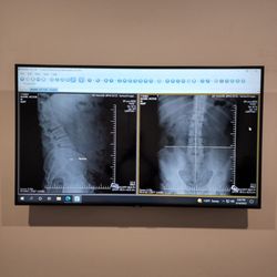 BackFit Health + Spine - My injury x-rays