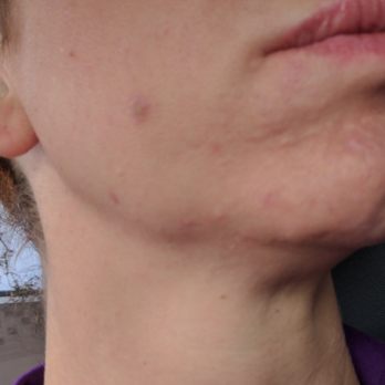 Laser Hair Removal On Face Chin Now I Have Cystic Ingrown Hairs