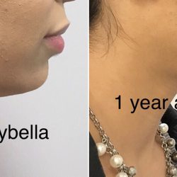 Kai - The Medical Spa - Absolutely No results after two treatments of Kybella!