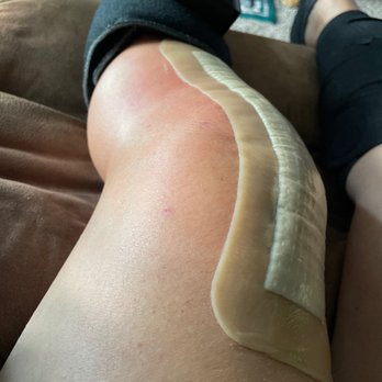 Excelsior Orthopaedics - Surgical knee with VenaGo leg massagers that they give you. - Sports Medicine Near Me - Amherst, New York Excelsior Orthopaedics - Surgical knee with VenaGo leg massagers that they give you. - Sports Medicine Near Me - Amherst, New York