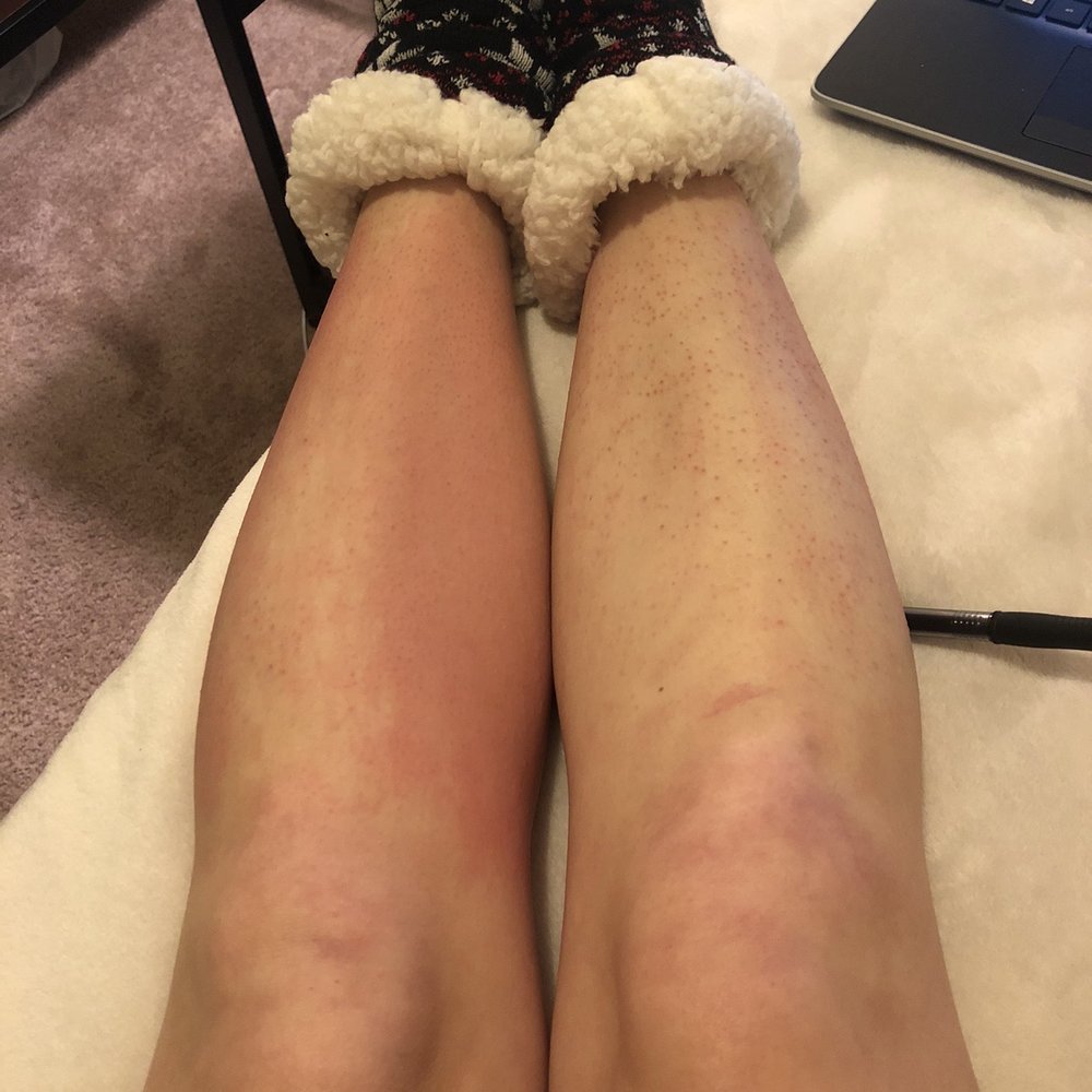 Luxury Nails - My burned legs - Nail Salons Near Me - Nottingham, Maryland