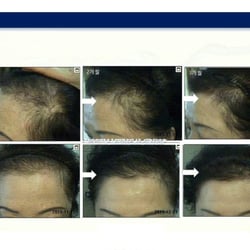 LaPrin - Scalp Care