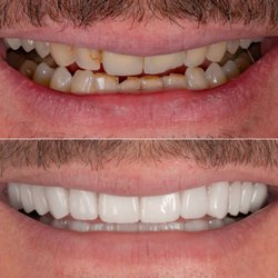 Sunset Dental Studio - Full mouth Makeover with porcelain veneers