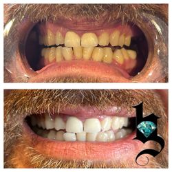 Hidden Gem LA - Before and after 1 hour session teeth whitening under
