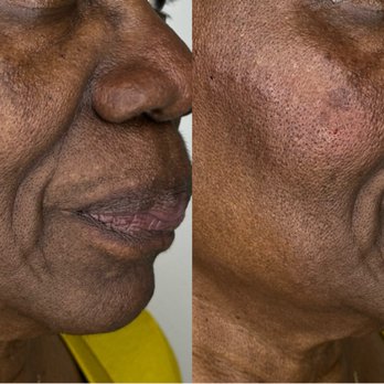 Natural Beauty Aesthetix - This Beauty wanted a touch of volume in her cheeks for subtle rejuvenation. - Skin Care Near Me - Silver Spring, Maryland Natural Beauty Aesthetix - This Beauty wanted a touch of volume in her cheeks for subtle rejuvenation. - Skin Care Near Me - Silver Spring, Maryland