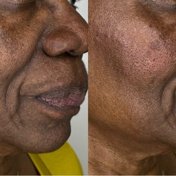 Natural Beauty Aesthetix - This Beauty wanted a touch of volume in her cheeks for subtle rejuvenation.