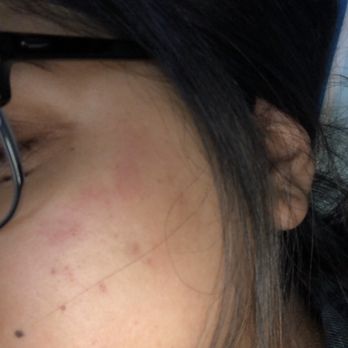 S.b.h Studio - This was my skin later that night after my "facial" . The date is on the picture so you can see it was the day of my facial . - Estheticians Near Me - Corona, California