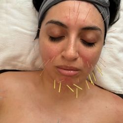 ACUREVERSE - Facial Acupuncture + lymphatic drainage