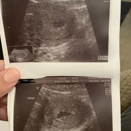 My ultrasound. I was maybe 4 weeks