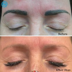 Newhope Laser Skin Care: Phuong Tien, MD - Eyebrows tattoo result after 6 treatments with our state of the art PICO laser