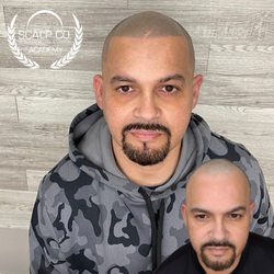 Scalp Co - Scalp Micro Pigmentation