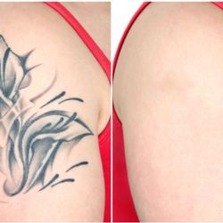 Laser Institute of North Carolina - Before and after using Revlite SI
