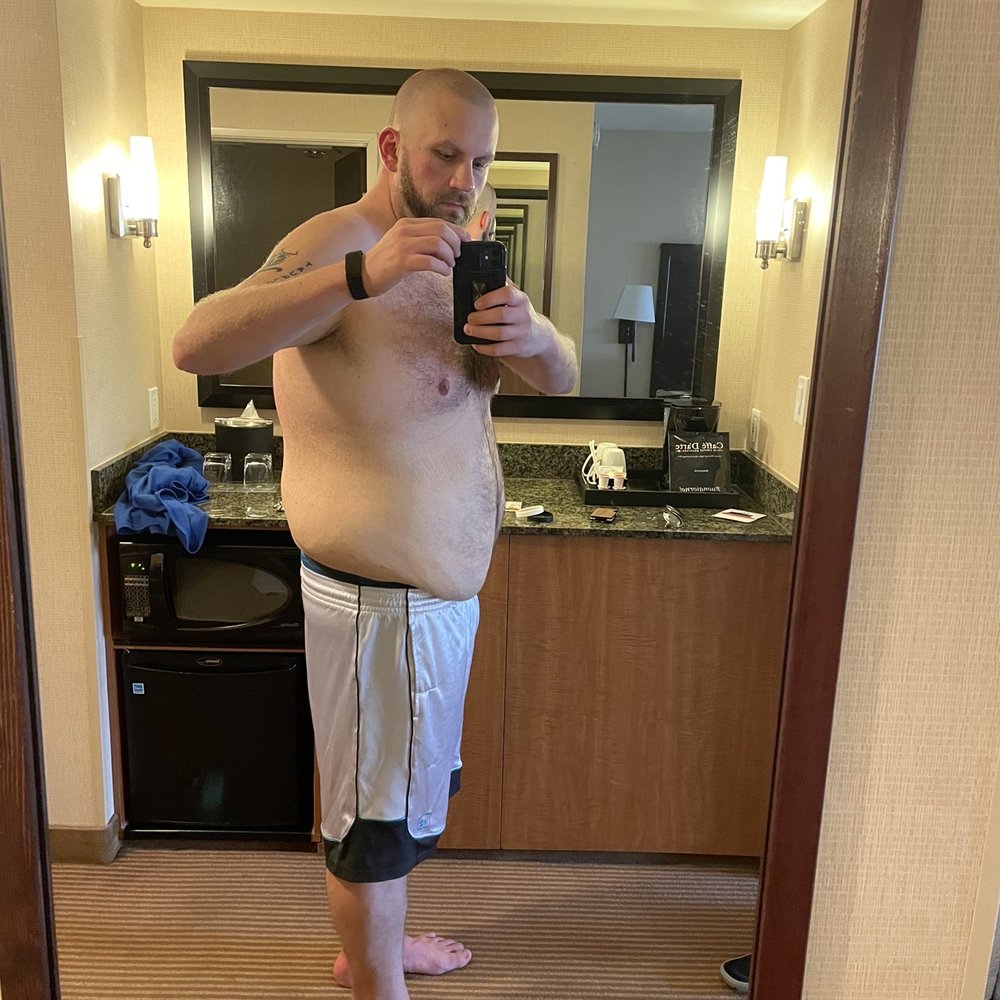 This was the day before surgery. Side This was the day before surgery. Side