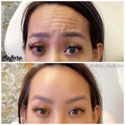 Xeomin anti-wrinkle injections