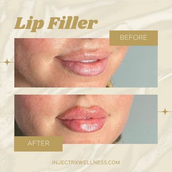 InjectRx Wellness - Lips filler before and afters - Medical Spas Near Me - Boca Raton, Florida