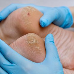 Foot & Ankle Center of Frisco - Our podiatrists are ready to help heal your cracked heels and keep your feet looking and feeling their best.