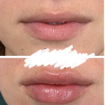 Macro Med - *NOT MACRO* my lips before filler (top) & after bad experience elsewhere (bottom). Lumpy + uneven. - Medical Spas Near Me - Corona, California