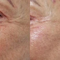 Marya Skin Care - My anti-aging facial after 1 treatment. You can see her skin is rejuvenated and her wrinkles and lines have softened up.