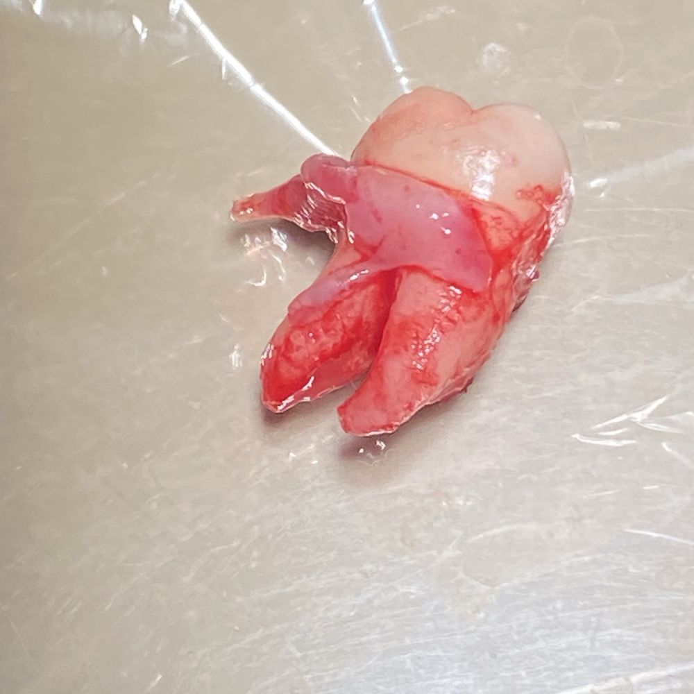wisdom tooth