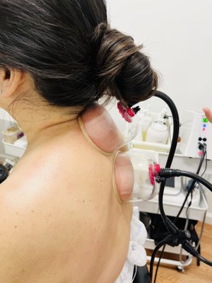 Back Detoxification and Cupping - This unique treatment combines the benefits of back exfoliation, Gua-Sha, cupping and a herbal mud mask to eliminate toxins, relieve stress, pain, improve immunity and stimulating the body circulation. Clients will have different feeling like Hot, Cold, Spicy or no feeling when applying the mud cream. It is really depends on the body condition. Back Detoxification and Cupping - This unique treatment combines the benefits of back exfoliation, Gua-Sha, cupping and a herbal mud mask to eliminate toxins, relieve stress, pain, improve immunity and stimulating the body circulation. Clients will have different feeling like Hot, Cold, Spicy or no feeling when applying the mud cream. It is really depends on the body condition.