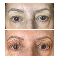 Euphoria Esthetics - Upper Eyelid Lift, Immediately following treatment