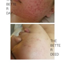 JK Aesthetic - No matter how severe your acne and acne scars, we can quickly get your skin clear, bright, and beautiful.