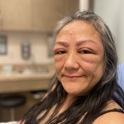 RapidCare Emergency Room - Katy 24hr Urgent ER Care - My severe allergic reaction to eye brow dye.They took great care of me and I'm on the road to looking my normal self again.
