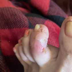 Advanced Foot & Ankle Care Centers - Blister eruption