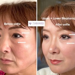 Mehryar Ray Taban MD - Oculoplastic Surgeon - 59 year-old Asian woman underwent customized Asian upper blepharoplasty and lower blepharoplasty.