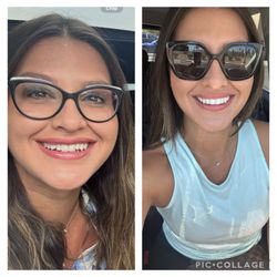 Hollywood Smile Dental - Before and after veneers