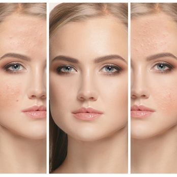 Capri Med Spa - Acne Treatment Near Me - Glendale, California Capri Med Spa - Acne Treatment Near Me - Glendale, California