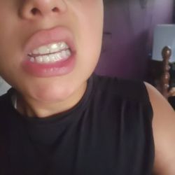 Smaha Orthodontics - Daughter's fresh new smile day her braces came off.