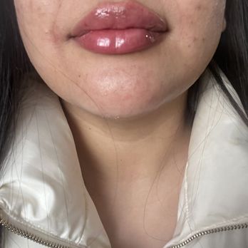 The Glow Method Skin Bar - My lips are swollen since this is a pic right after my lip filler - Skin Care Near Me - Tempe, Arizona