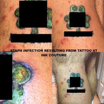 Ink Couture, NYC - Staph infection as a result from a tattoo at Ink Couture - Tattoo Near Me - Staten Island, New York