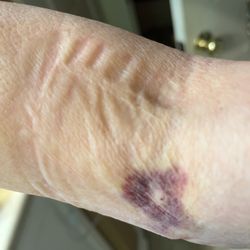 Candler Hospital - After the bandage was removed.