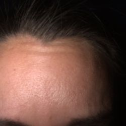 Dr. Jeunesse - Forehead lines still show