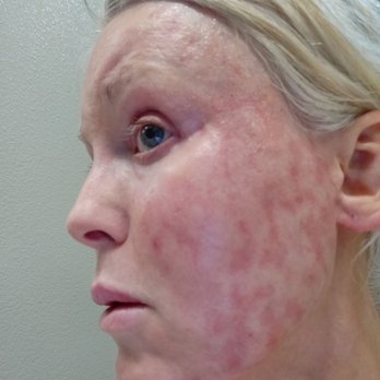 Robert Shumway, MD - Pic taken on 5/12/20. Surgery was 12/16/19 - Cosmetic Surgeons Near Me - San Diego, California Robert Shumway, MD - Pic taken on 5/12/20. Surgery was 12/16/19 - Cosmetic Surgeons Near Me - San Diego, California