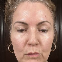 Athré Facial Plastics - Before photo