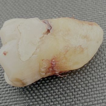 Dentistry of Bellevue WA - Bas seal! Leaving big holes. - Cosmetic Dentists Near Me - Bellevue, Washington Dentistry of Bellevue WA - Bas seal! Leaving big holes. - Cosmetic Dentists Near Me - Bellevue, Washington