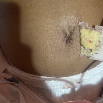 Seduction Cosmetic Center - My new belly button two days post while getting it cleaned! - Cosmetic Surgeons Near Me - Coral Gables, Florida Seduction Cosmetic Center - My new belly button two days post while getting it cleaned! - Cosmetic Surgeons Near Me - Coral Gables, Florida