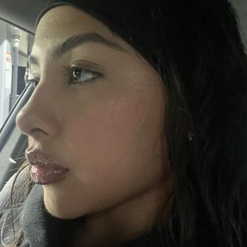 The Aesthetic Suite - day after masseter botox - Medical Spas Near Me - Tomball, Texas