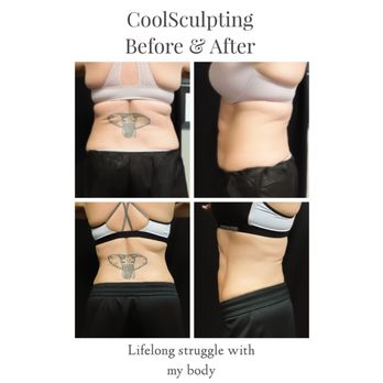 Arizona Aesthetics - CoolSculpt before and after - Medical Spas Near Me - Scottsdale, Arizona