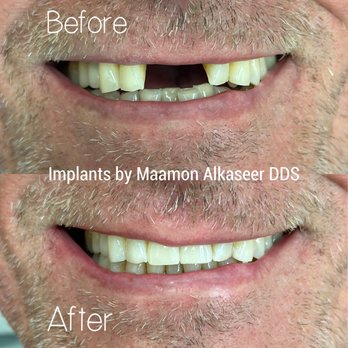 Jamacha Dental - dental implants by doctor Alkaseer to restore missing teeth at Jamacha Dental in El Cajon - Cosmetic Dentists Near Me - El Cajon, California Jamacha Dental - dental implants by doctor Alkaseer to restore missing teeth at Jamacha Dental in El Cajon - Cosmetic Dentists Near Me - El Cajon, California