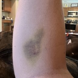 Blood draw bruise still here after 1 wk. Blood draw bruise still here after 1 wk.