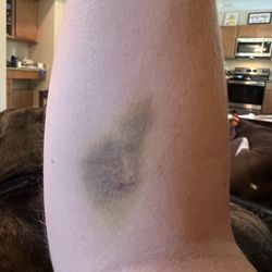 Quest Diagnostics - Blood draw bruise still here after 1 wk.