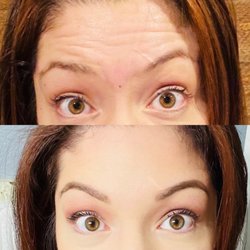 Banerji Plastic Surgery - Forehead wrinkles before and after