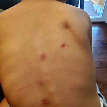 Happy Little Faces - The concerning bruises on my son's back that none of the preschool caretakers were able to explain - Preschools Near Me - Concord, California