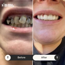 HB Smile Dental - Before and After for patient at HB Smile Dental